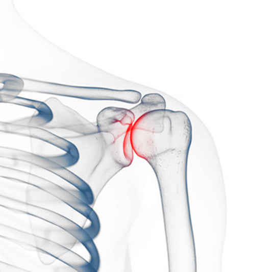 Schulterprobleme im Kraftsport: Impingement-Syndrom durch muskuläre Dysbalance